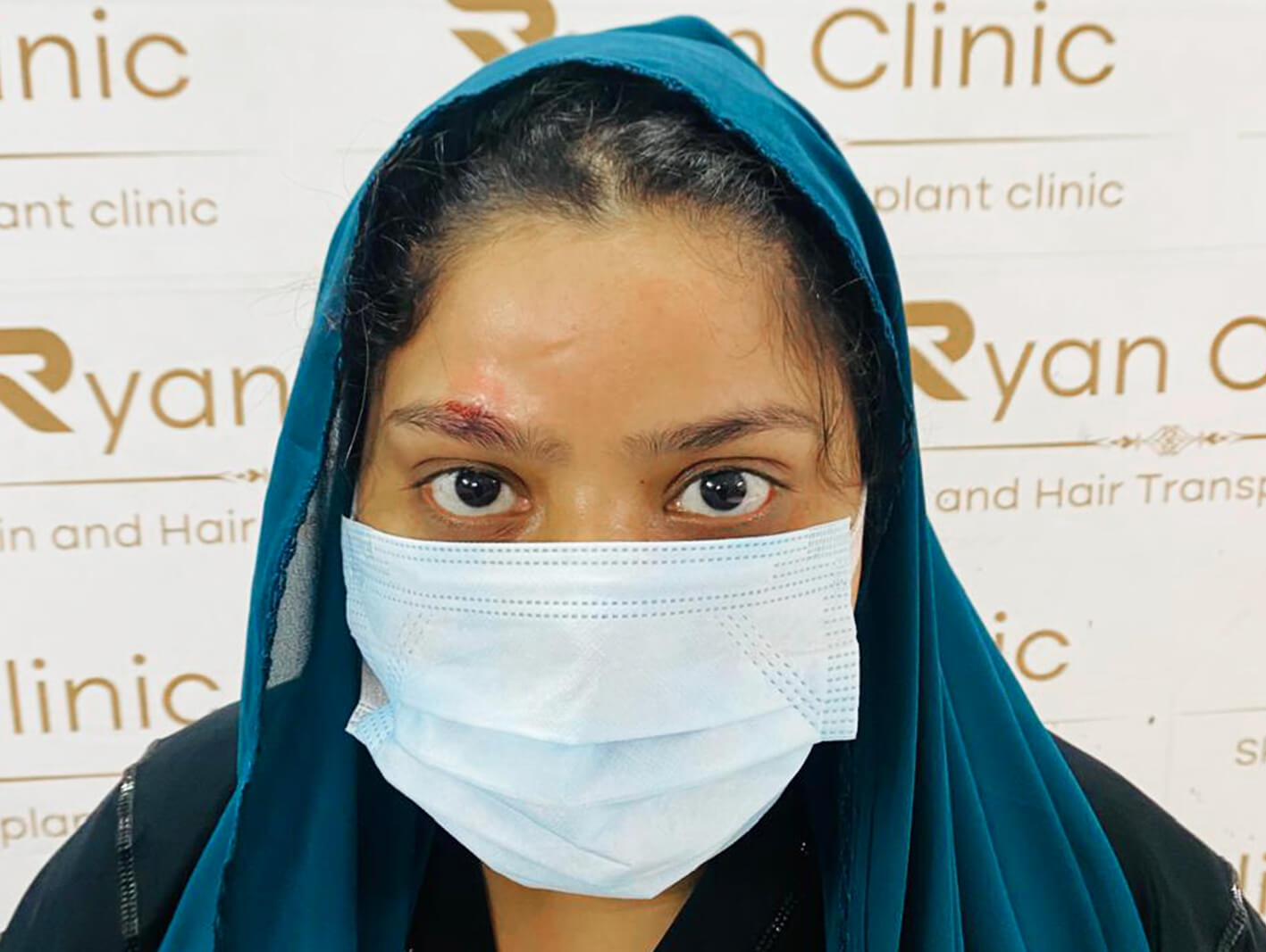 Eyebrow transplant procedure